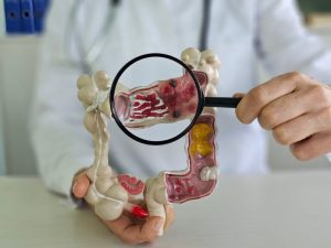 Colon-Cancer