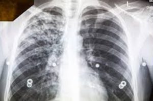Tuberculosis
