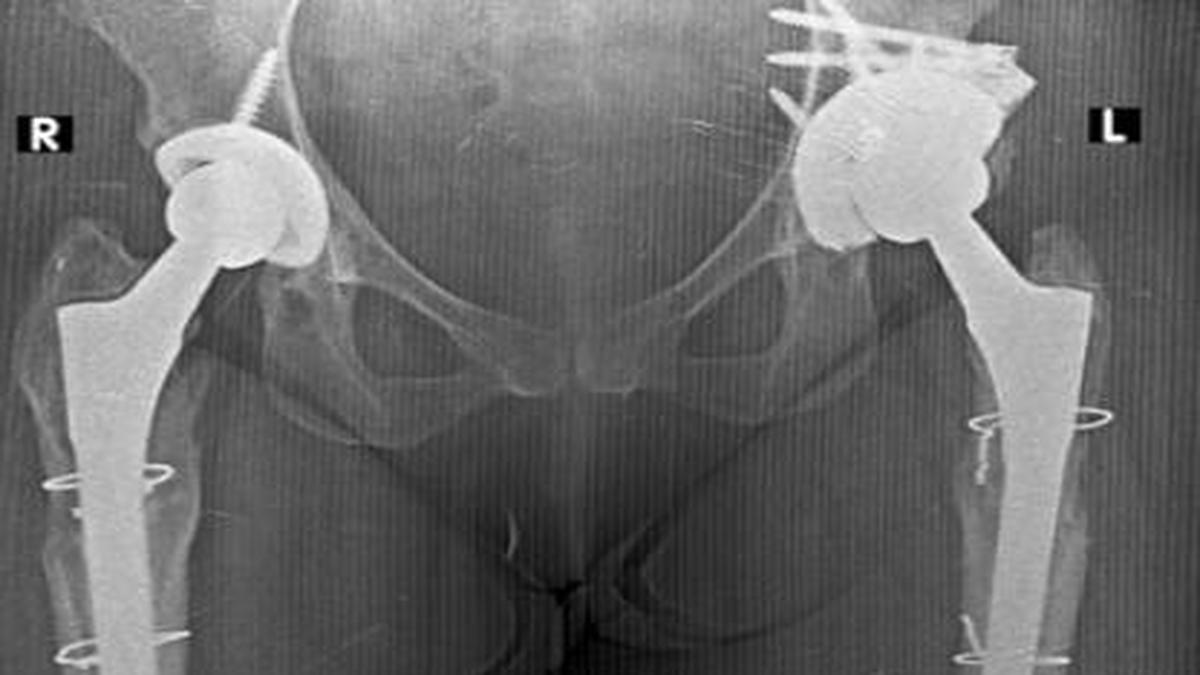 Hip Replacement Infections Rise Globally